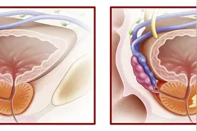 为什么急性炎症容易被治愈？而慢性炎症很难根除？图片