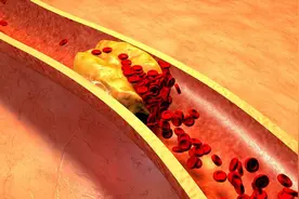 什么是颈动脉狭窄，拖到这一程度，或招来脑梗图片