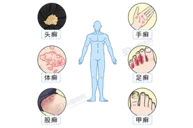 得了灰指甲，反复发作很难受？一次性介绍3种药，总有一款能起效图片