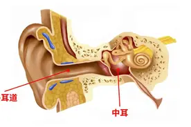 长期佩戴耳机，耳朵“出水”—外耳道炎的这些事你要知道图片