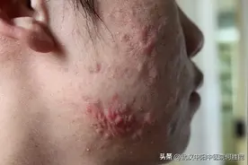 下巴反复长红肿硬硬的痘痘是什么原因引起的?图片