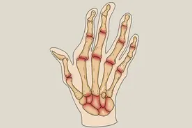 更年期女性，晨起后手指发胀，僵硬疼痛，咋回事？详述5种病因图片