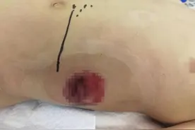 济南9岁男孩被“二踢脚”炸伤，现仍未脱离危险 ，医生：孩子安全意识差慎放鞭炮图片