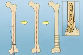 骨折手术用的钢板和钢钉，钛合金和不锈钢的哪个好？图片