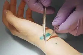 外伤用可吸收线缝合，就是美容缝合？医生告诉您：用错，一样留疤图片