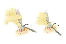 自体真皮瓣隆鼻是怎么回事？图片