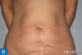 腹壁整形术后3个月，“袋鼠”妈妈变“小腰精”，聊一聊我的经历图片
