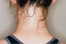 头颈部爱出汗，头发经常打湿？中医：多是5个原因，教你如何止汗图片