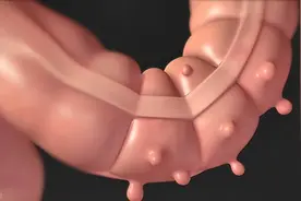 溃疡性结肠炎治疗目标的现状与挑战图片