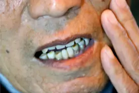 牙齿松动了，还能稳固吗？有必要拔掉？不想真牙掉光，预防牙周炎图片