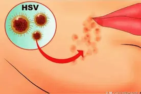 烂嘴角其实是感染了疱疹病毒图片