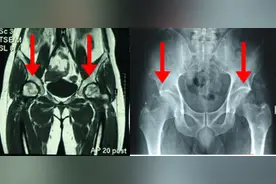 股骨头坏死的分期（第4期）图片