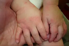 小手密集的小疙瘩是什么东东？图片