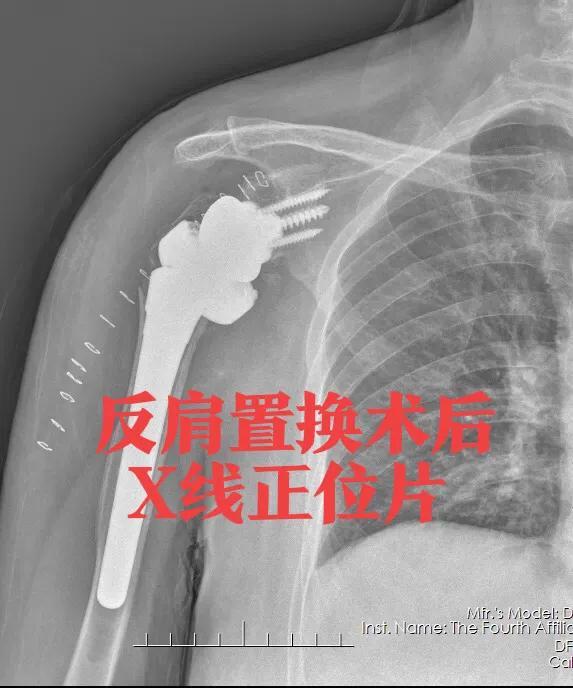 肱骨近端骨折系列之合并大结节撕脱性骨折治疗