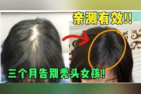 头顶炸毛了！这三个防脱生发好物绝了！秃头星人千万不要错过！图片