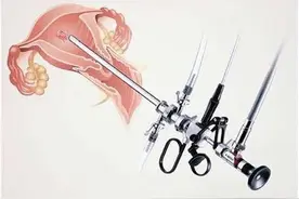 什么是宫腔镜？宫腔镜可以治疗哪些疾病？图片