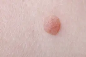 脖子和腋下的“小肉粒”是什么？能直接用手揪掉吗？告诉你答案图片