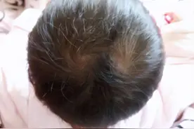 孩子头上的“旋”代表什么？与智商和性格有关吗？医生告诉你答案图片