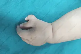 都说多指就是多福？孩子多长的拇指还需要切掉吗？图片