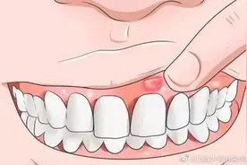 牙龈鼓包为啥要做根管治疗？图片