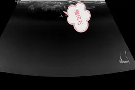 大踇脚趾反反复复疼和肿，居然是这个原因？图片