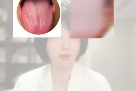 舌头变成这些颜色说明什么？（舌象第三节）#舌苔图片