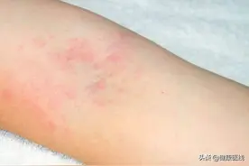 红疹、瘙痒痛苦难耐，避免熬夜、勤晒被褥，让你远离“疥疮”尴尬图片