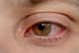 眼底出血的原因，有哪些？图片