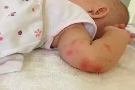 痒到挠破皮！孩子被蚊子咬，用对3招，防蚊止痒阻挠图片