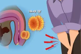 男人得了淋病会有什么症状？图片