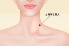 不痛不痒的肿块，一查便是恶性淋巴瘤！身体有肿块的，教你自查图片