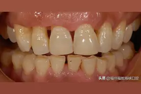 牙缝大是什么征兆？牙医：牙缝变大的主要原因、解决方法已整理好图片