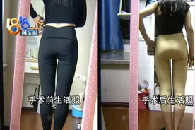 术后趴睡半个月，“抽的”和“填的”都不满意图片