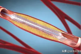 心脏支架有寿命吗？装了后，还用不用取？装支架前，这些得知道！图片