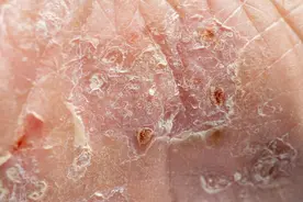 患有糖尿病的人为什么脚会烂掉？和这几个原因有关，注意预防图片