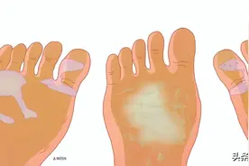 脱了鞋就熏一屋子，脚臭怎么办？图片