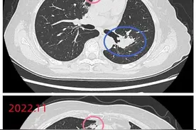 肺癌术后癌胚抗原持续走高，但影像却没发现转移，怎么办？图片
