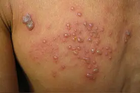 私生活切忌不要太“放纵”，6种通过“性传播”的病你知道几个？图片