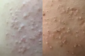 痘痘的分类-（闭口粉刺）图片