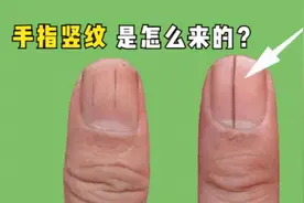 指甲上的月牙、白点、竖纹代表什么？医生告诉你指甲与健康的真相图片