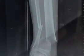 骨折对身体有什么影响？图片