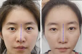 网友留言：假体隆鼻两年后越来越歪斜，千万别隆鼻！图片