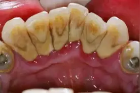牙结石引发牙周感染？过来人紧急支招，在家轻松清除整片牙石！图片
