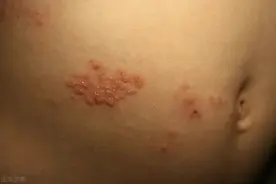 “缠腰蛇”带状疱疹剧痛难忍，应该怎么治？这些方法可以快速治疗图片