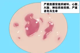 一经感染，终身标记，梅毒到底有多可怕？图片