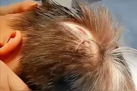 4岁男童幼儿园摔伤颅骨缝4针，园方没监控不清楚如何摔伤，当地教育部门调查称是意外事故图片