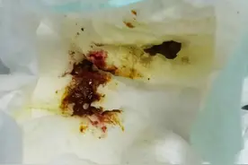 【科普】半个月大的宝宝便血，原因竟出在母乳上？图片