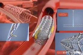 心脏装了支架后，还能活多少年？医生说出实情，望你能接受图片