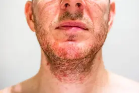 油光满面，得了面部脂溢性皮炎，该怎么办？图片