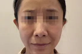 做拉皮手术这一年我45岁，术后变成35？分享一下我的经历图片